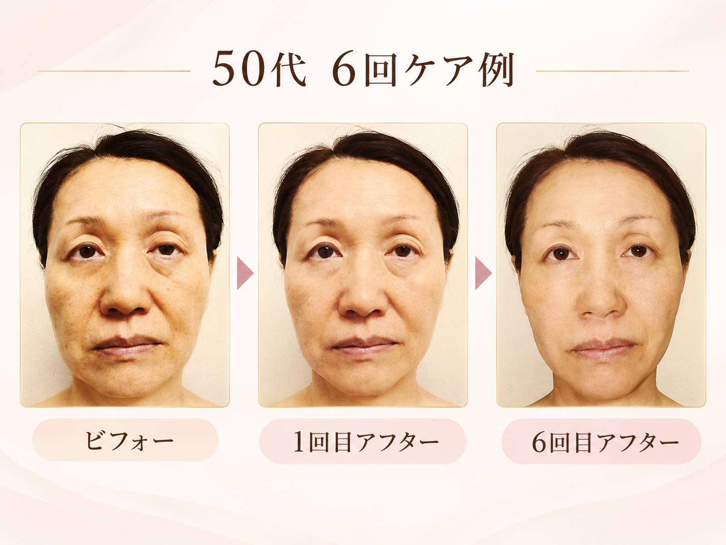 50代女性の施術前・1回目施術後・6回目施術後の比較